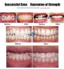 Invisible Braces Orthodontic Braces